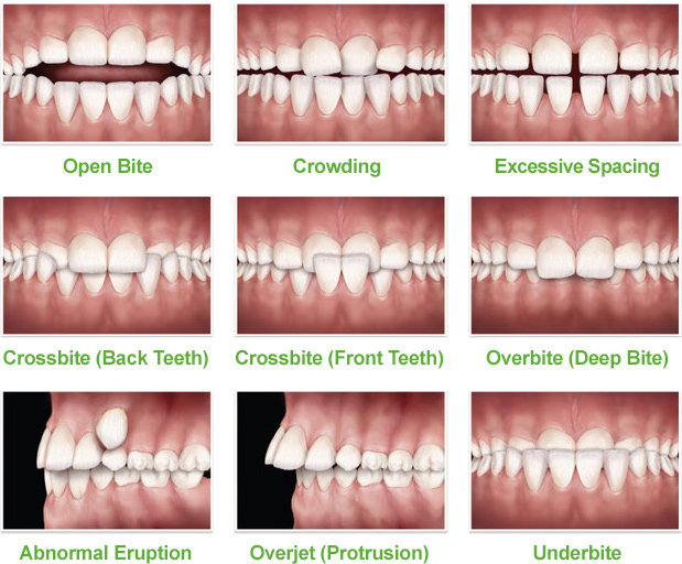 earlyorthodontic-problems