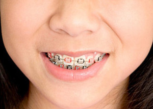 braces