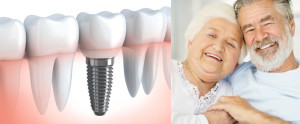 tooth implants