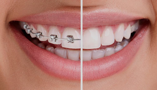 braces for adults newmarket