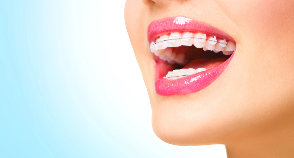 dentist for ceramic braces newmarket