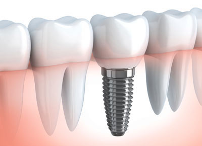 dentist for dental implants newmarket