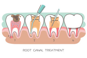 root canal therapy treatment newmarket